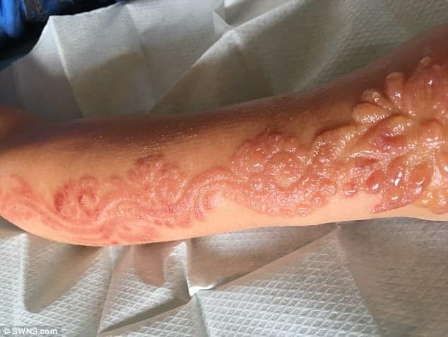 PARENTS WARNED OF TEMPORARY TATTOO DANGER | House Call Doctor
